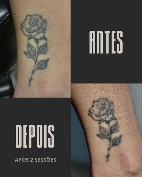 Remoção de Tatuagens a Laser