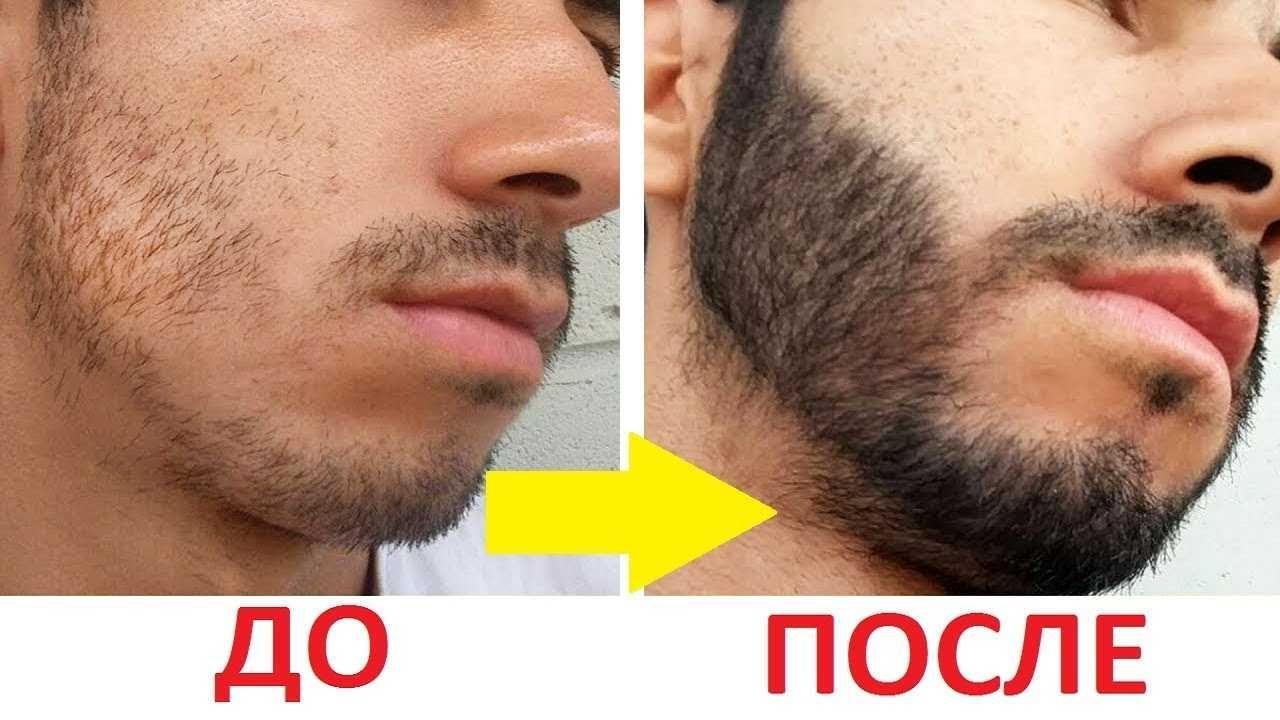 ДЛЯ МУЖЧИН! Гель моментального действия для роста БОРОДЫ Италия АКЦИЯ ...