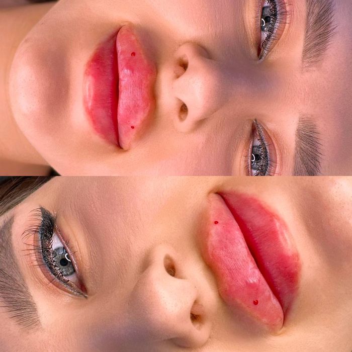 Косметолог. Акция. Увеличение губ по цене препарата