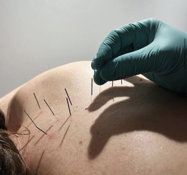 Akupunktura i terapia manualna