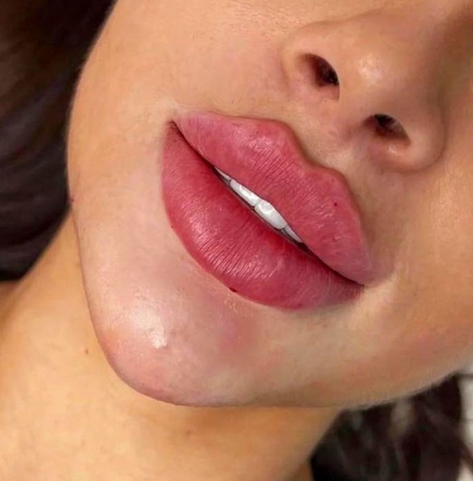 Похудение,ботокс,губы,рф,смасс,косметолог