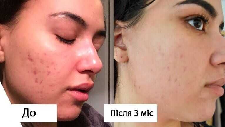 Третиноїн гель для проблемної шкіри A-ret gel 0,05%, 20г., Індія