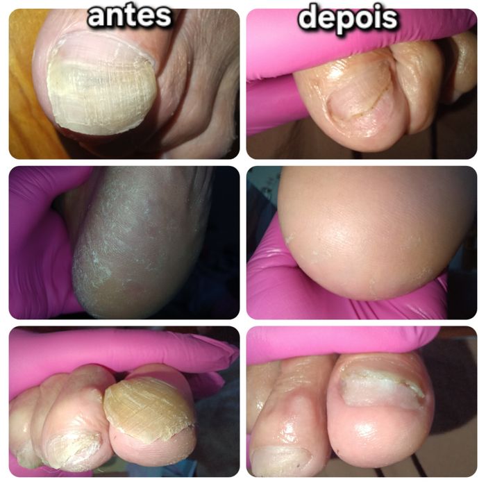 Pedicure medicinal ao domicílio