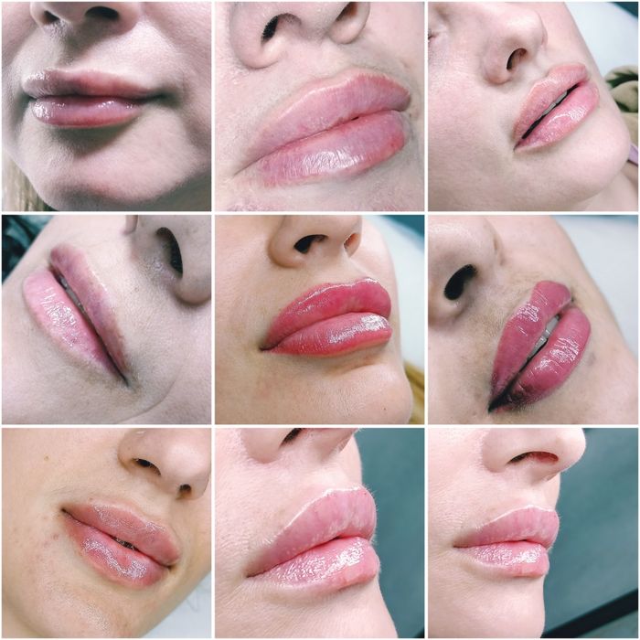 Косметолог. Контурна пластика губ, мезотерапія, біоре-ція, ліполітик.