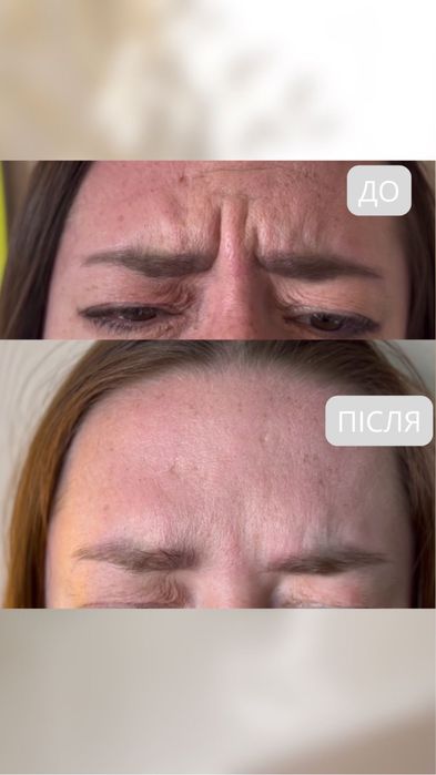 Косметолог|Ботокс|Контурна пластика губ.Центр міста