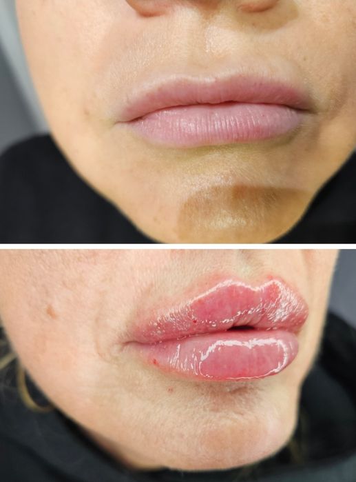 Mega promocja!Usta ,btx,Stymulatory, nici