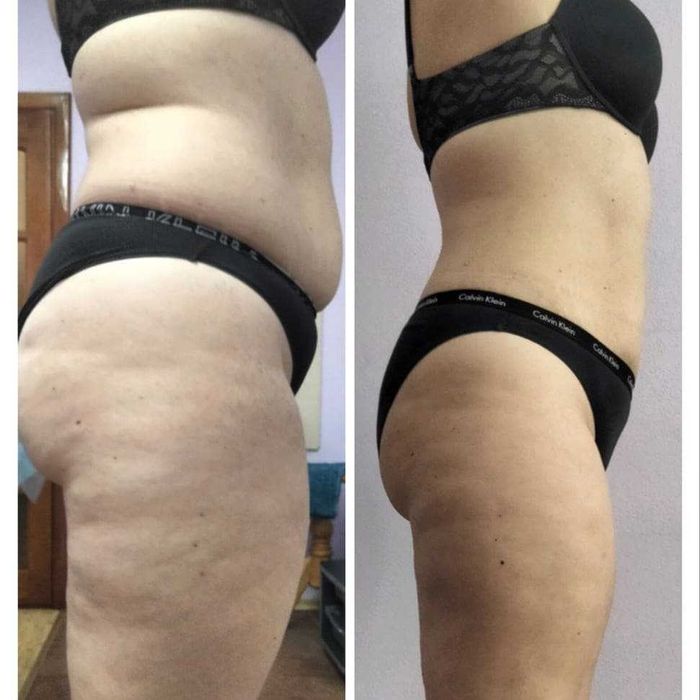 Антицеллюлитный массаж