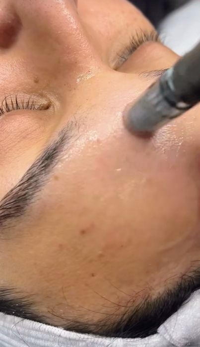 Hifu, microagulhamento, Microblading,