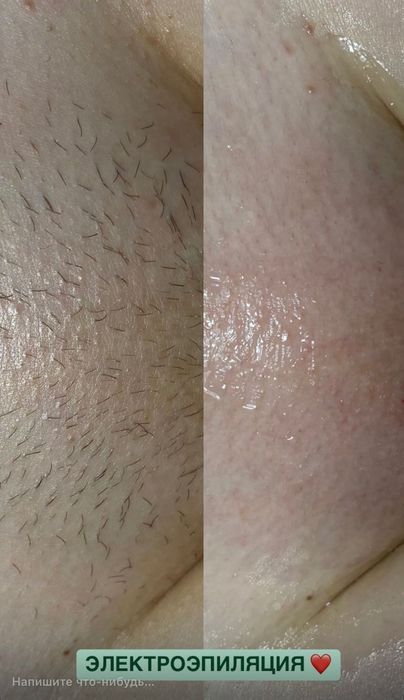 Лазерная эпиляция/Электроэпиляция/поселок Котовского