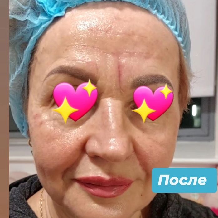 Косметолог Ботокс,  увеличение губ, липолитики