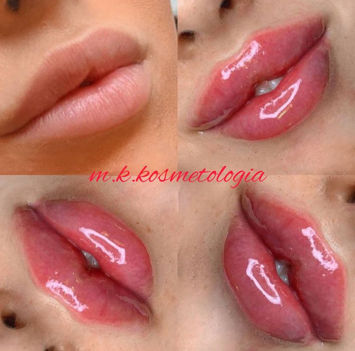 Косметолог ! Інʼєкційні процедури! Запоріжжя!