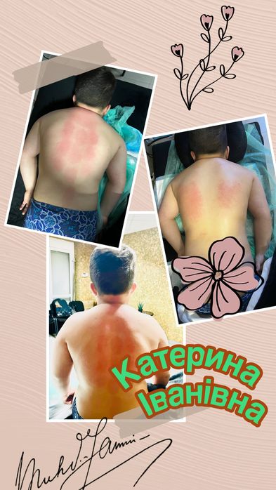 Масаж  та реабілітація!Стоун терапія лімфодренаж пресотерапія