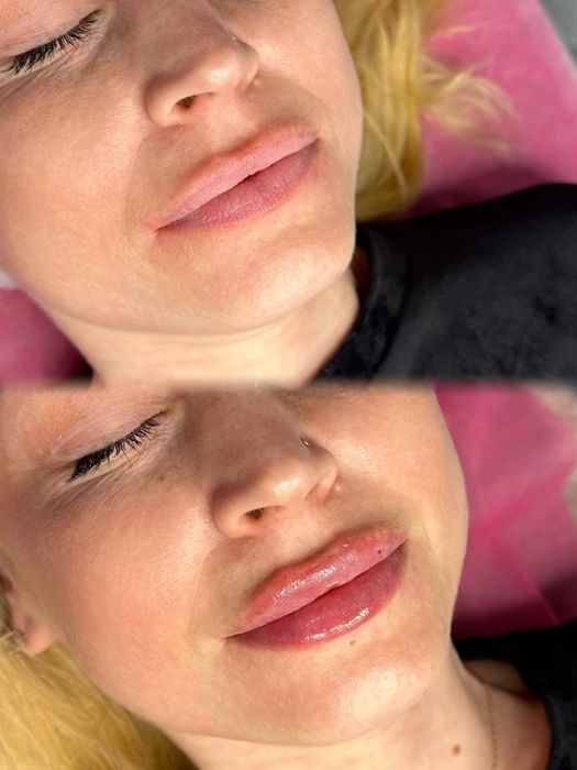 Косметолог|Ботокс|Контурна пластика губ.Центр міста