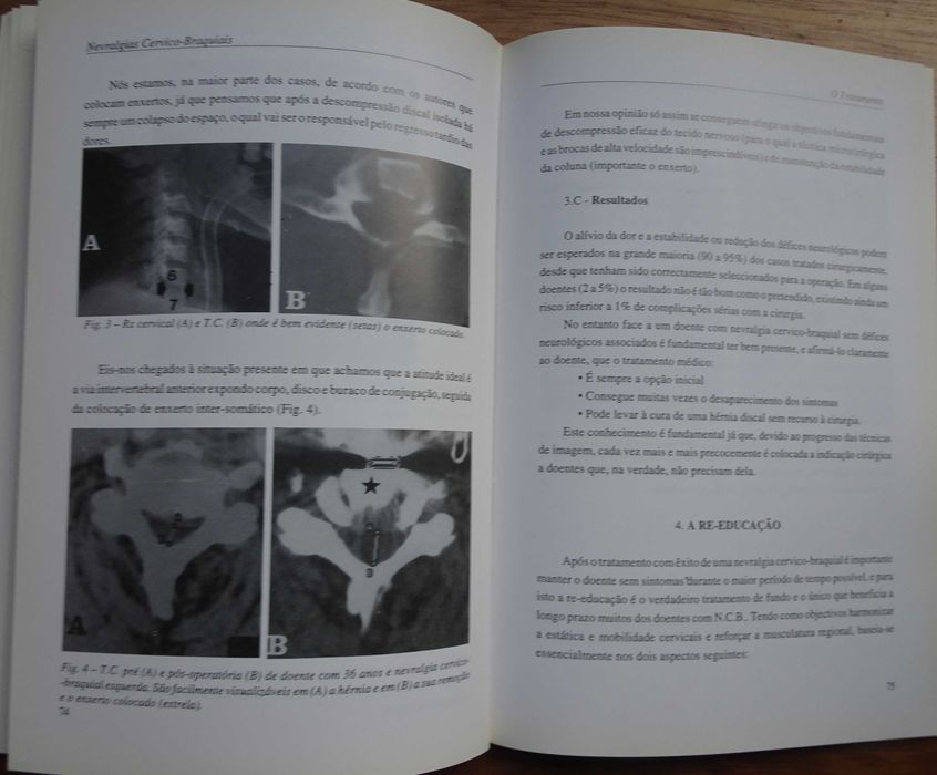 Nevralgias Cervico-Braquiais (Monografia) de Filipe Duarte e Rui Vaz