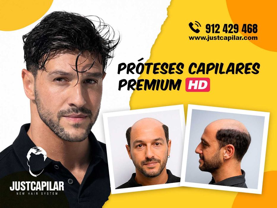 Prótese Capilar Micro Pele com Colocação e Corte, efeito real e imediato, em 2 horas volte a sorrir!