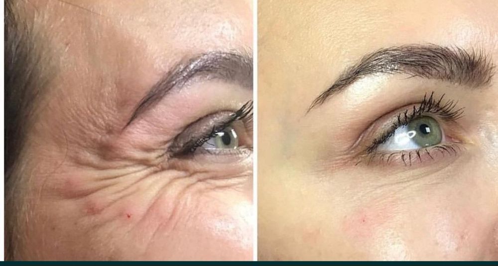 Губки ботокс гусинные лапки