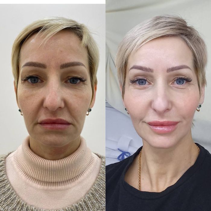 Увеличение губ, омоложение, косметолог , ботокс , биоревитализация.