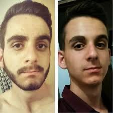 Minoxidil foligain extra forte + dermaroller