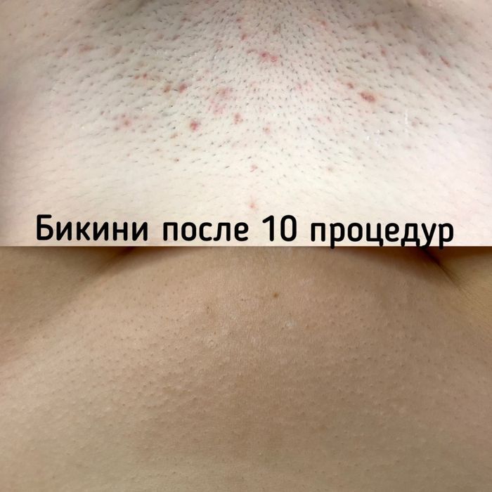 Лазерна епіляція, воскова депіляція, Геров Днепра, Оболонь