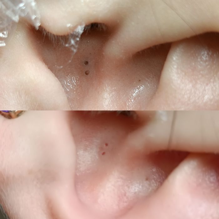 Косметолог Чистка лица Пилинг Rf лифтинг