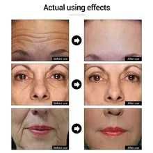 Портативный прибор синего света для устранения разных проблем кожи