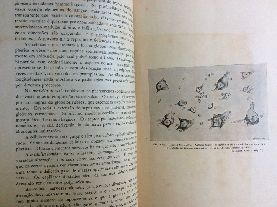 As alterações dos centros nervosos na meningite...1903