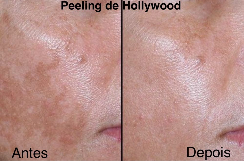 Tecnica de remocao de tatuagem, peeling e outros.