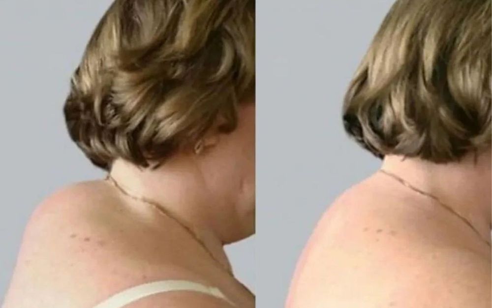 Лікування холки , корекція фігури