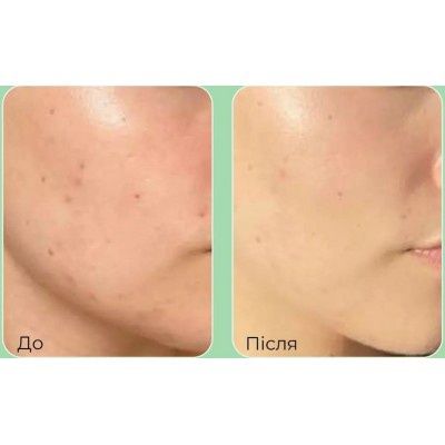 Пилинг-сыворотка со спикулами (микроиглами) и центеллой Medi-Peel С