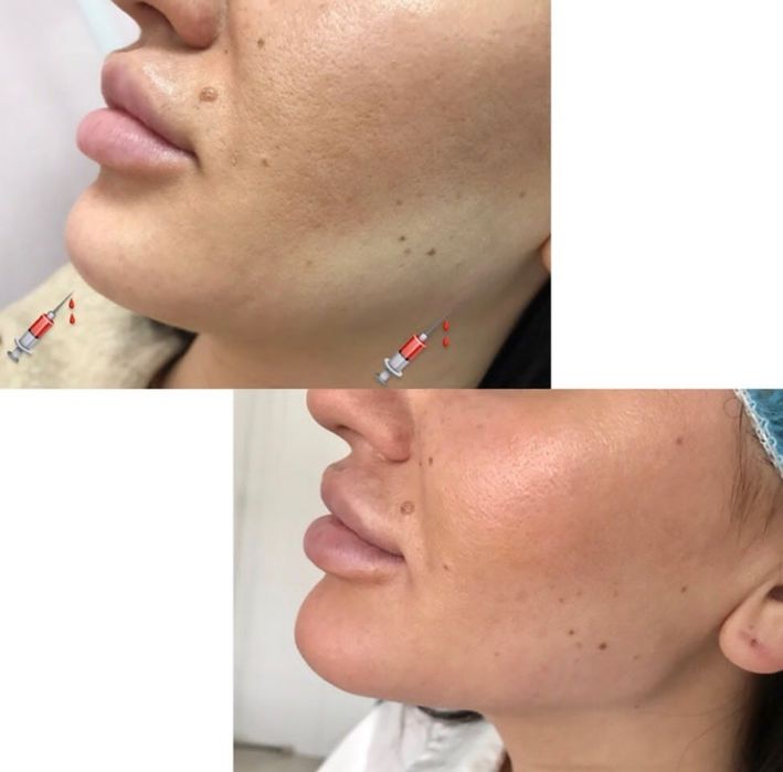 Косметолог. Губы . подбородок, углы нижней челюсти. Углы Джоли.