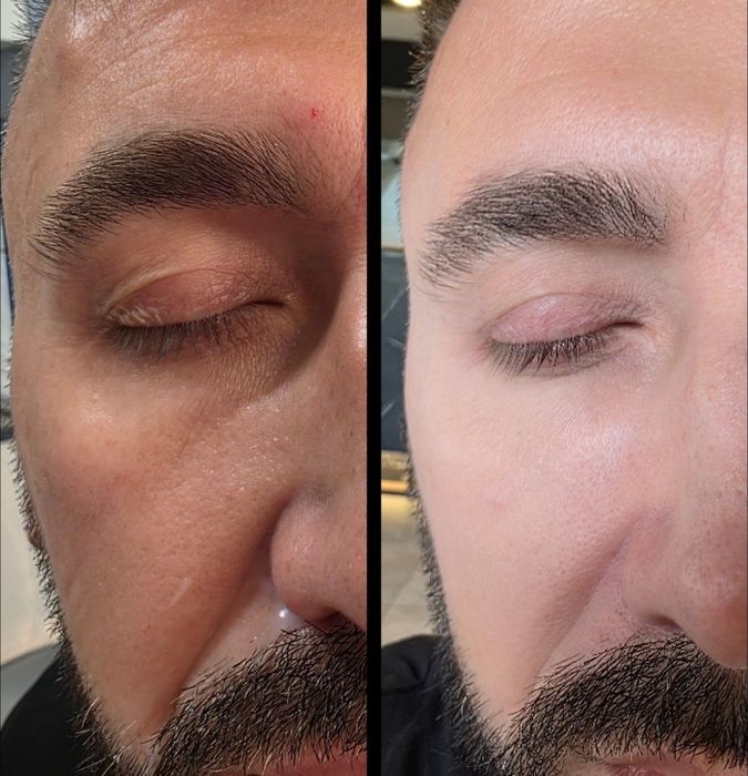 Promocja botox 1 okolica 150zł , usta 370