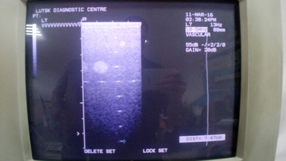 Лінійний датчик УЗД Siemens (Acuson) L7