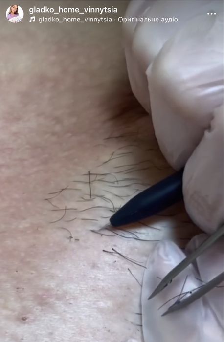 Електроепіляція, депіляція, шугаринг Вінниця