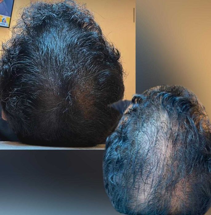 Micropigmentação capilar.