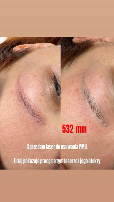 Laser Q - Switch usuwanie PMU Makijaż permanentny