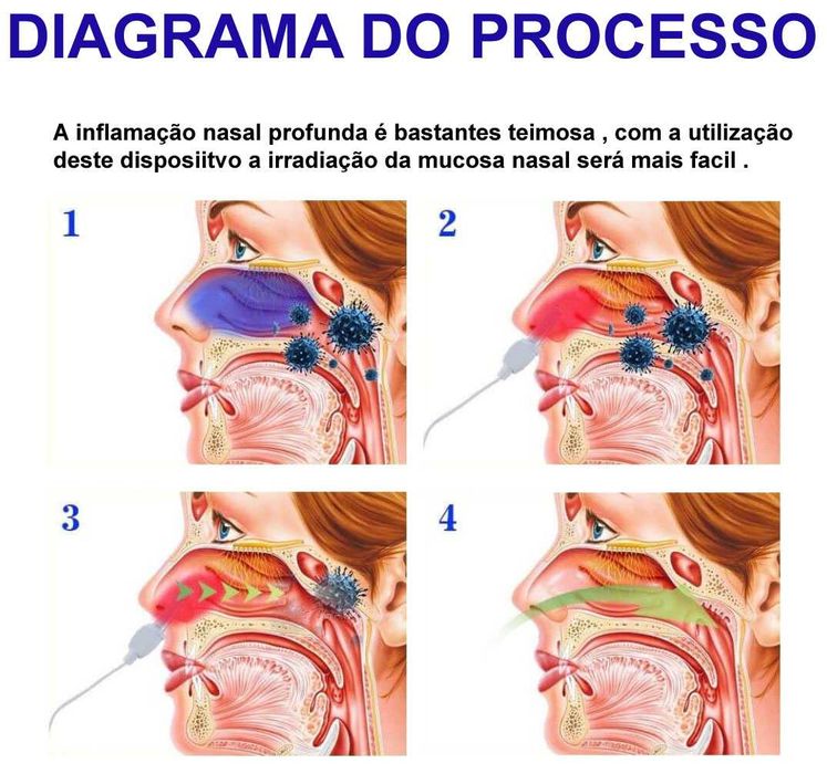 dispositivo de terapia de alergias nasais anti rinite ressonar polipos