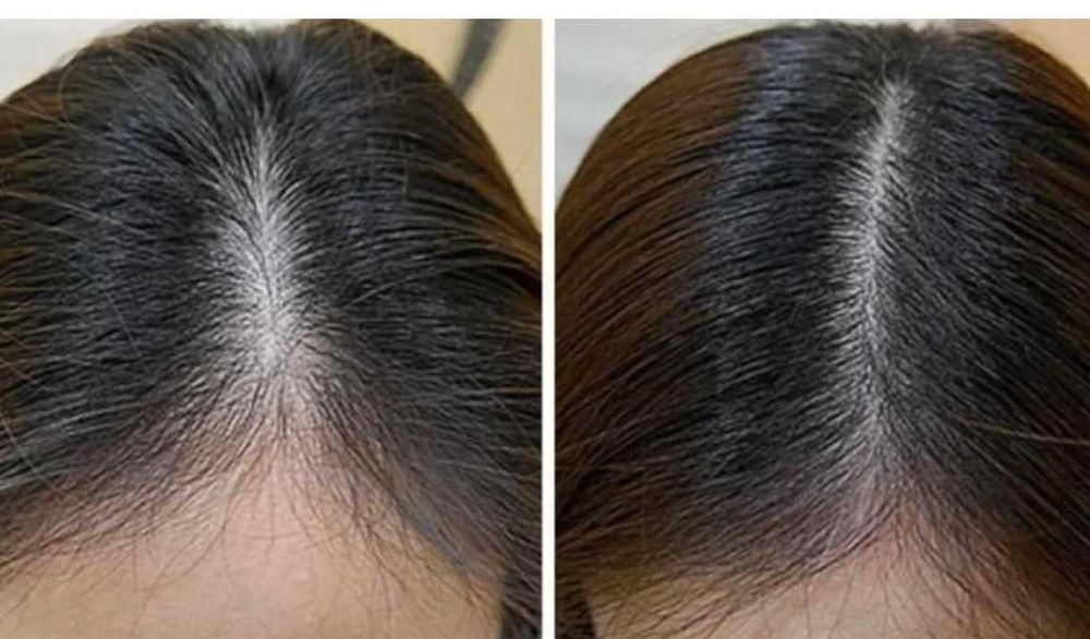 Usta/botox/mezoterapia