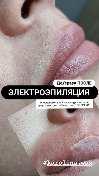 Електроепіляція та воскова депіляція. 10 років досвіду. Центр Бучі.
