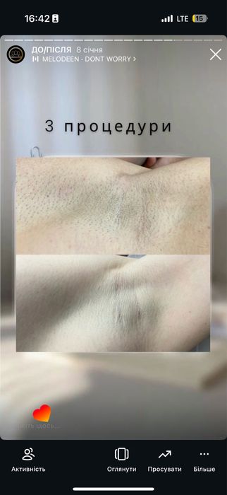 Лазерна епіляція