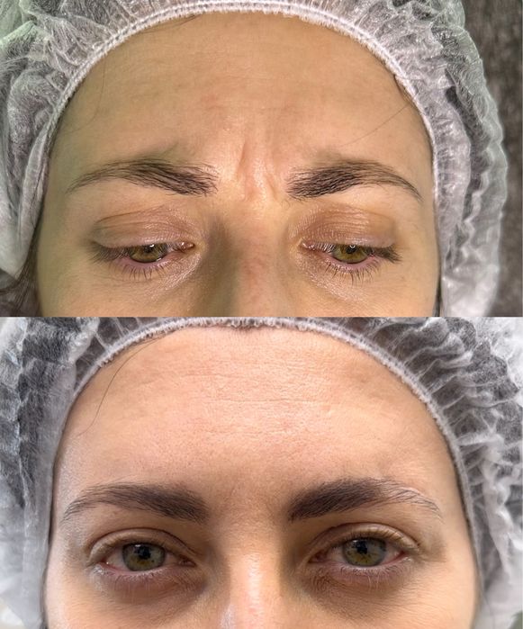 Ботулінотерапія по собівартості, модель ботокс від 500 грн АКЦІЯ