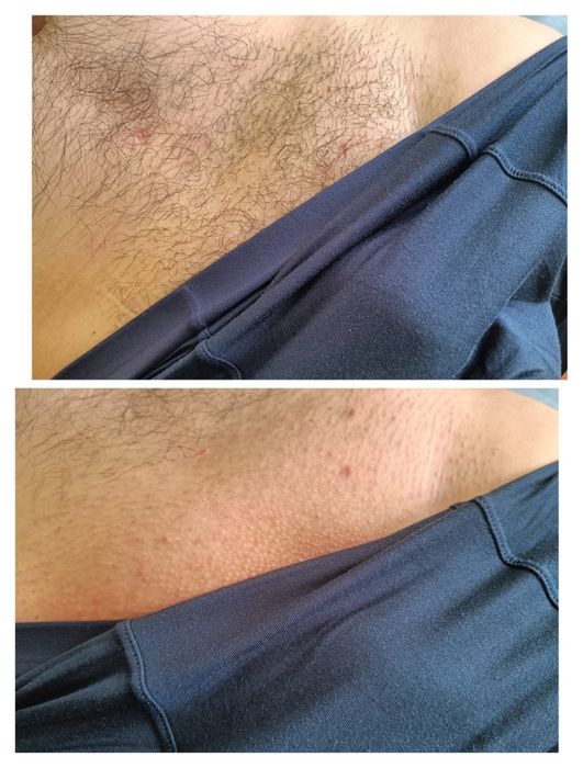 Депіляція для чоловіків, всі  зони