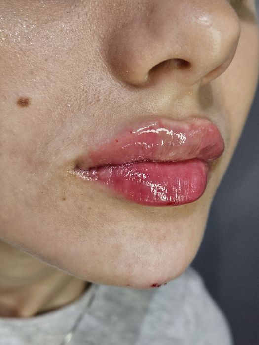 Promocja! Botox promocja 1 okolice 130zł do końca sierpnia