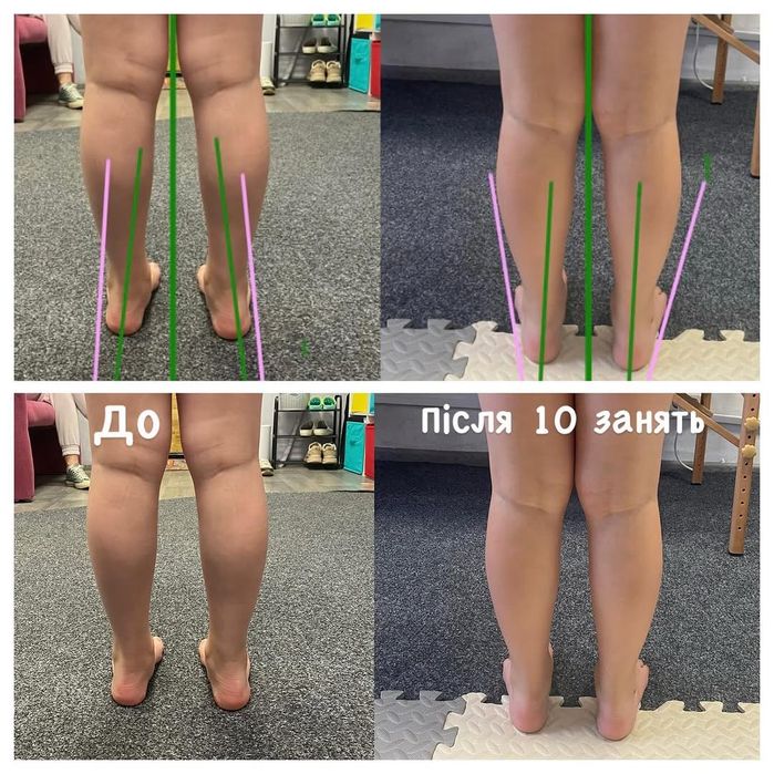 Дитячий масаж, ЛФК