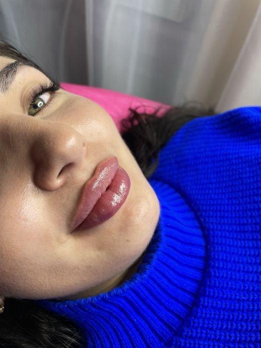 Збільшення губ , ботокс, косметолог