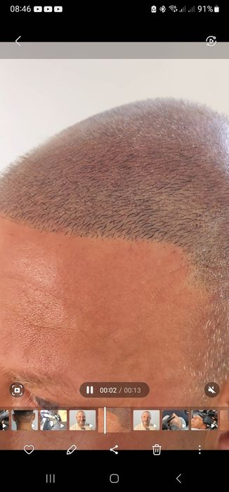 Micropigmentação Capilar fio a fio