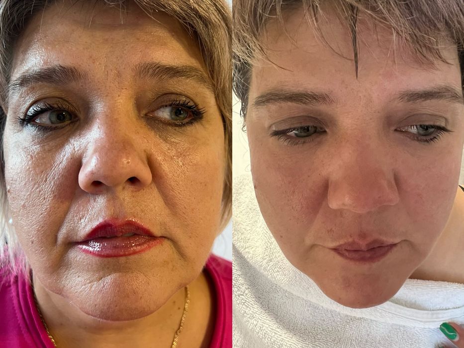 Лікування холки , корекція фігури