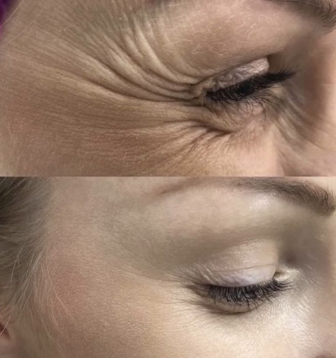 Ботулінотерапія по собівартості, модель ботокс від 500 грн АКЦІЯ