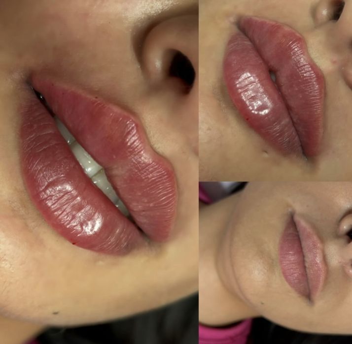 Botox, Powiększanie ust