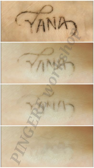 Безпечне лазерне видалення тату, татуажа.