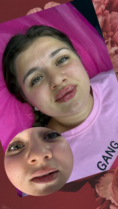 Увеличения Губ Контурная пластика,ботокс